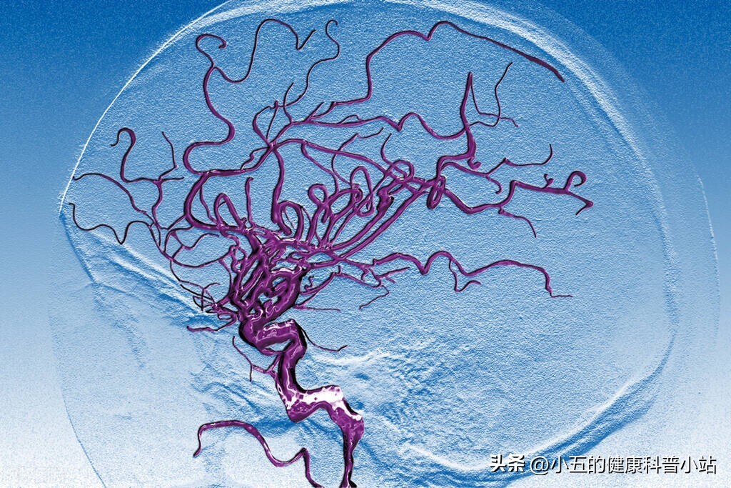 头晕脑供血不足怎么办快速缓解,经常头晕脑缺血吃什么药好