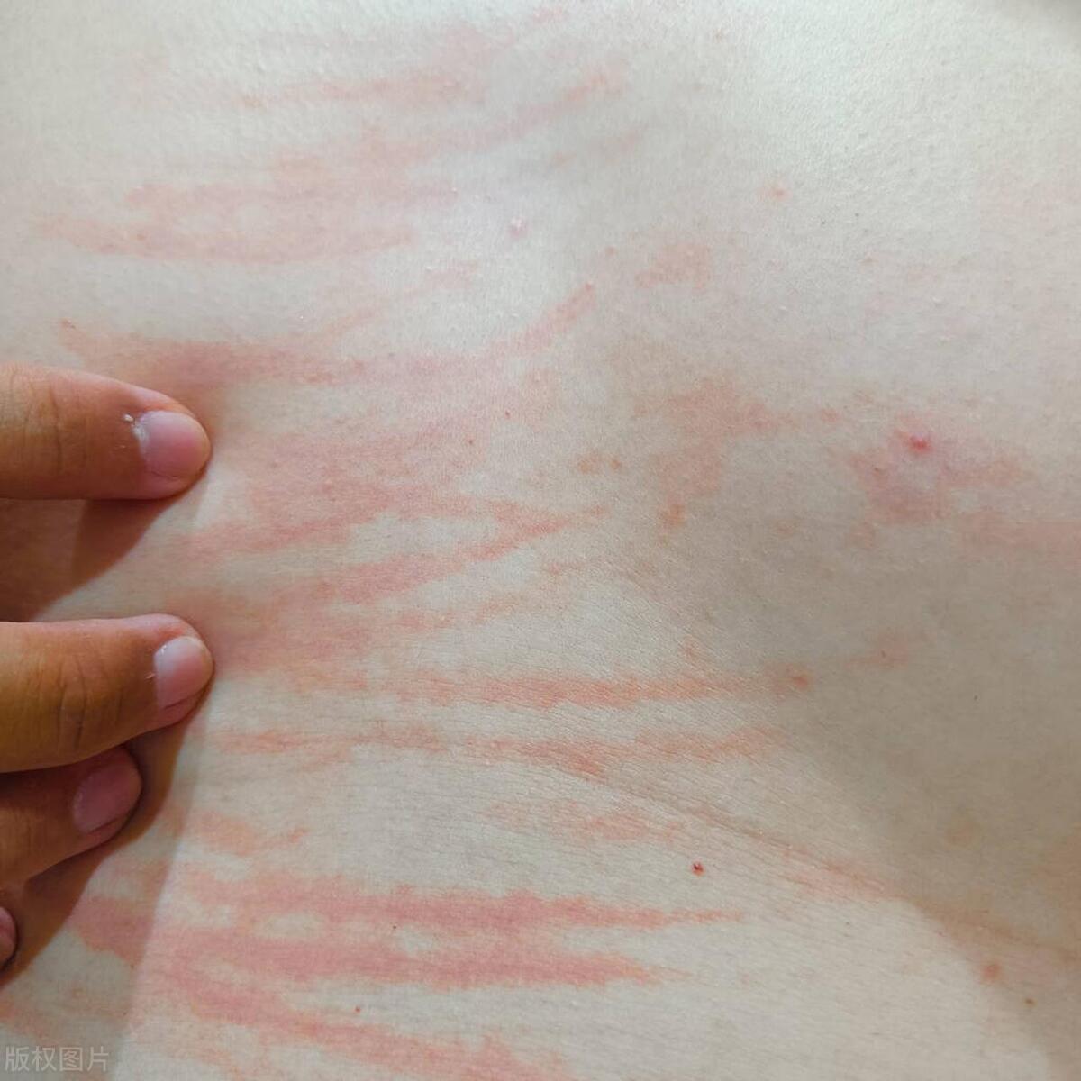 两月未互动，背后抓痕谜底，医生解释疥螨感染真相，挽救婚姻危机