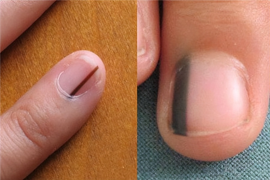 身上有癌指甲有什么变化,体内有癌皮肤先知6个信号别忽视