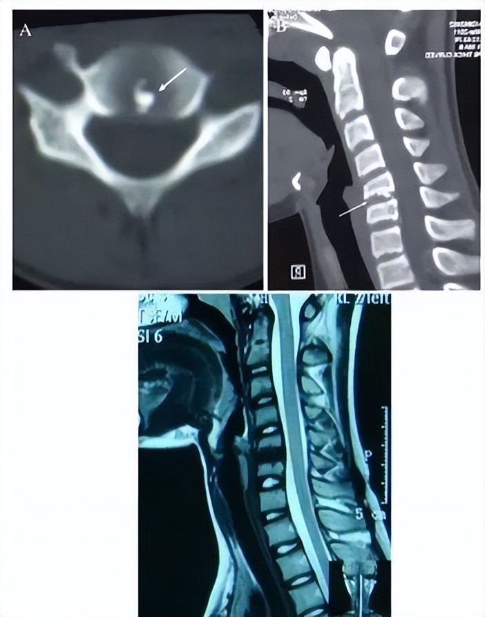 颈椎常见病变图片,颈椎严重的病例