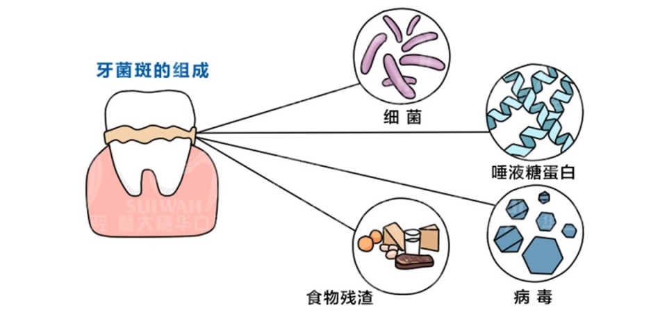 很久没刷牙有牙斑怎么去除,牙齿长了小黑点能靠刷牙解决吗