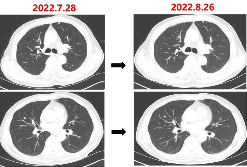 中国国内结直肠癌最新治疗,结直肠癌治好的可能性大吗