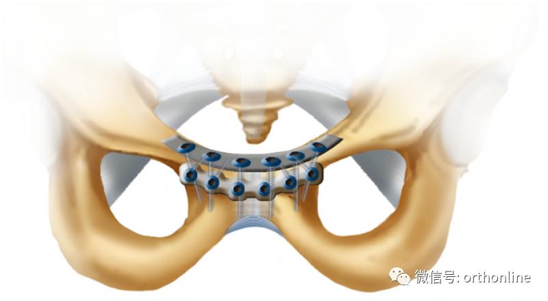 耻骨联合切开复位内固定临床操作与注意事项
