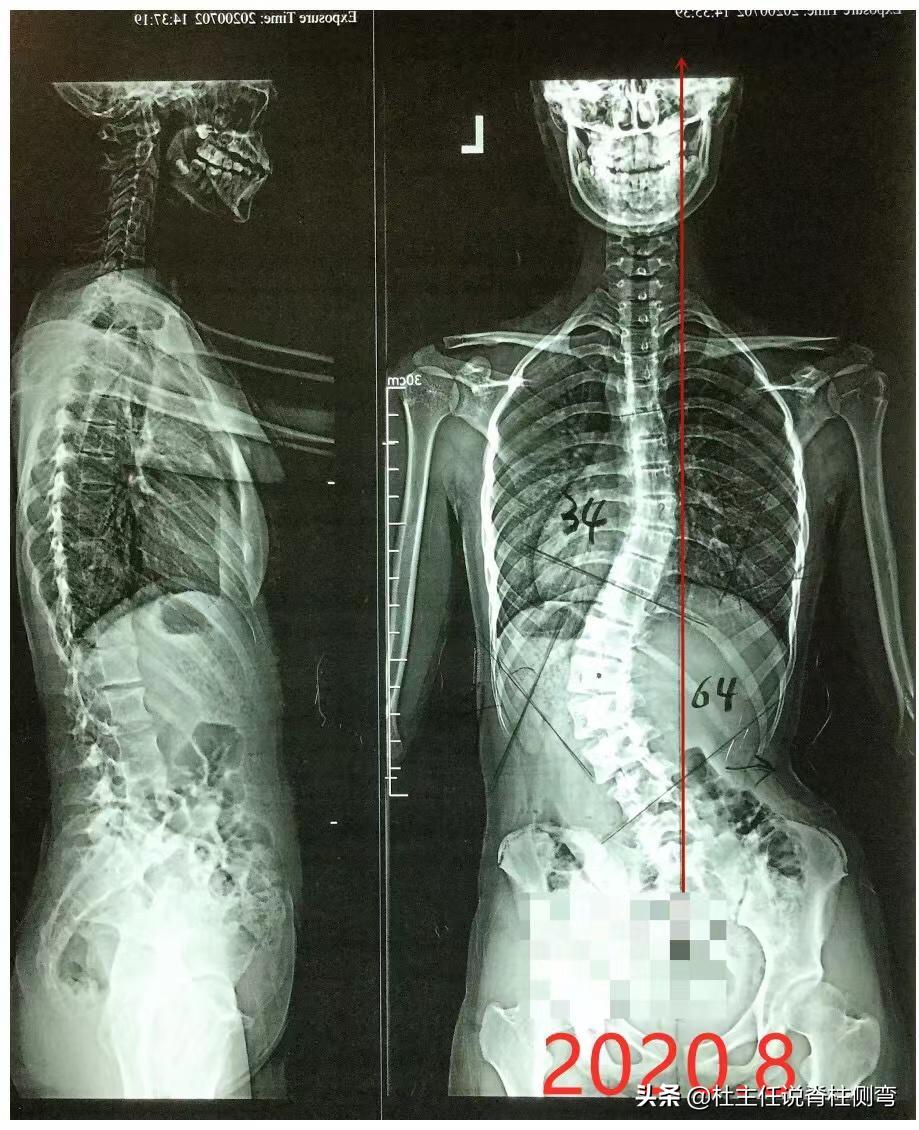 脊柱侧弯超过60度,还能选择保守治疗改善吗?恢复效果如何?
