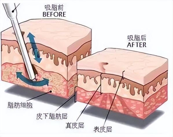 上海九院吸脂收费标准,九院韦敏面部吸脂