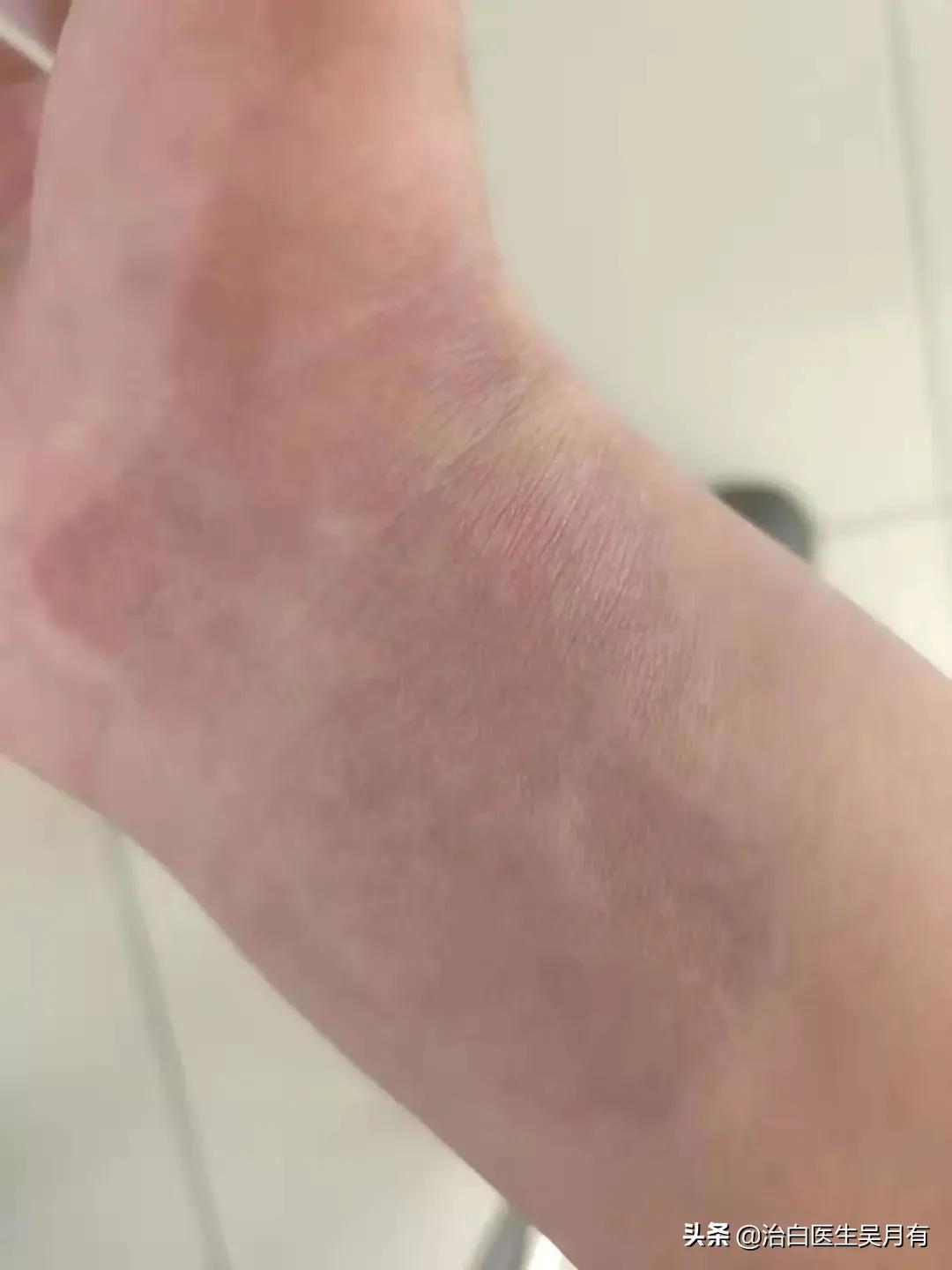 白癜风的治疗和类型有关？寻常型白癜风要注意的3件事