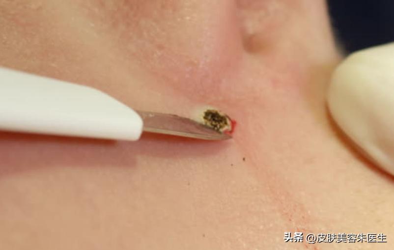 一周治愈尖锐性湿疣科学方法,刚发现尖锐性湿疣可以完全治愈吗