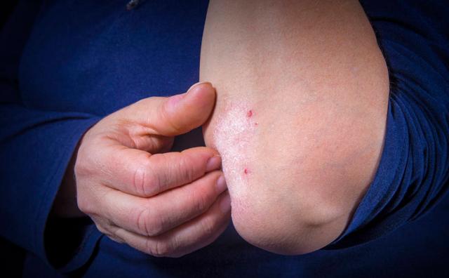 麻疹是什么病机,麻疹和荨麻疹的区别是什么