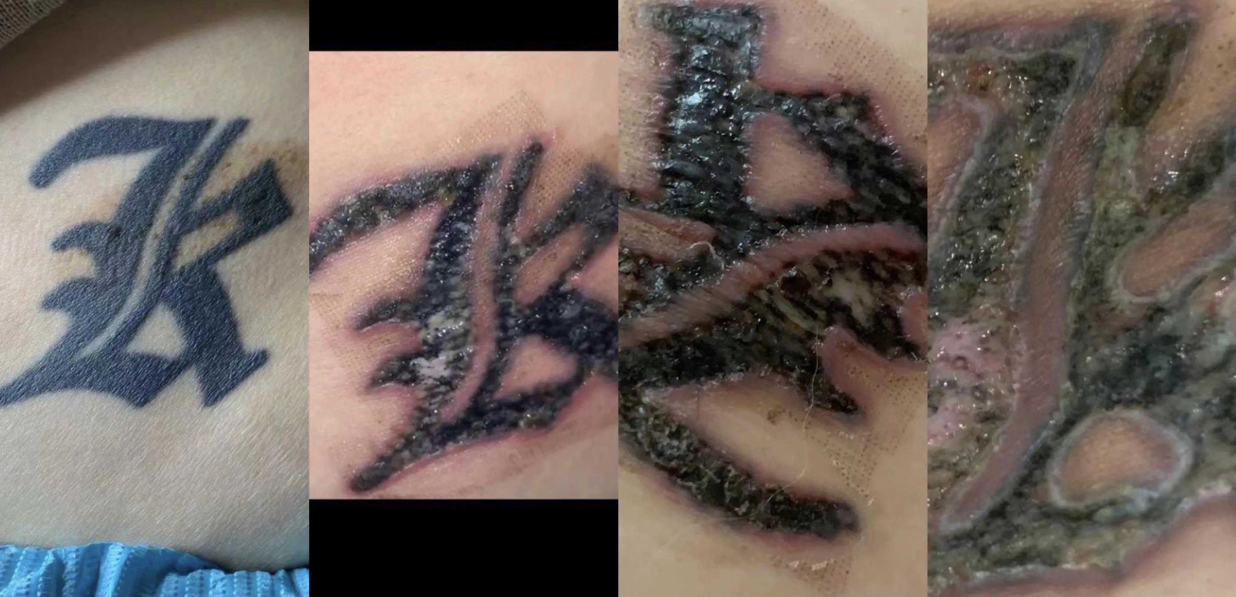 为洗纹身买单,洗纹身有什么代价