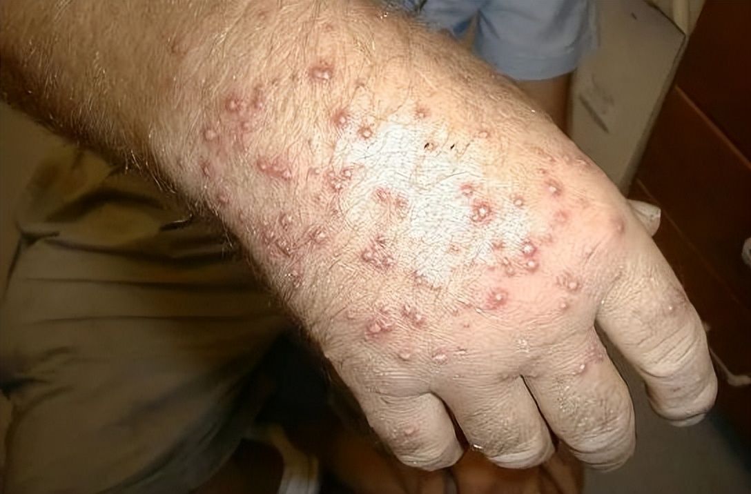 带娃出门游遇到蜱虫千万别乱拔,警惕这三种毒虫带娃出行必看