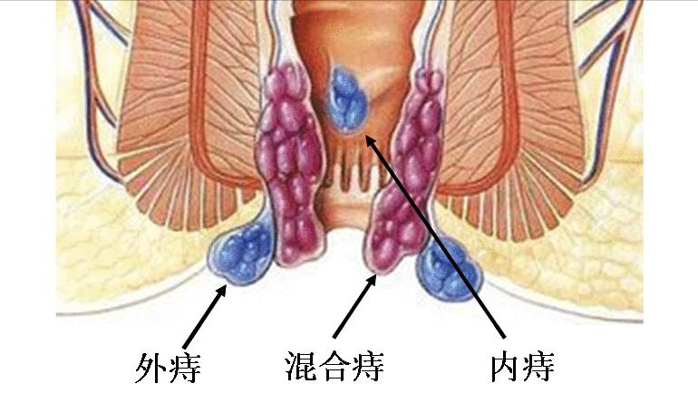 26岁女孩多次肛裂,女性哪些生活习惯会引发肛裂