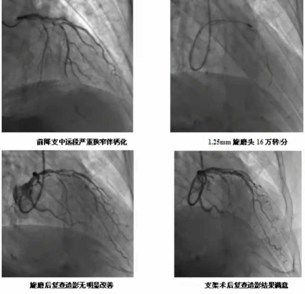 冠状动脉旋磨术,冠状动脉血管旋磨疏通手术