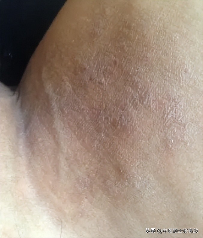 睾丸潮湿湿热用什么中药,睾丸潮湿下焦湿热怎么治疗