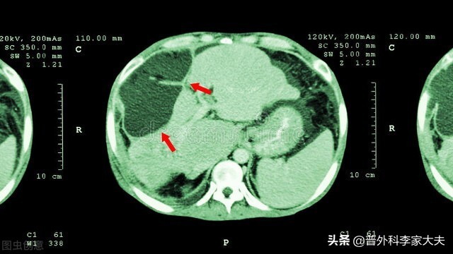 肝癌晚期可以带瘤生存吗,肝癌晚期出现黑便还能生存多久