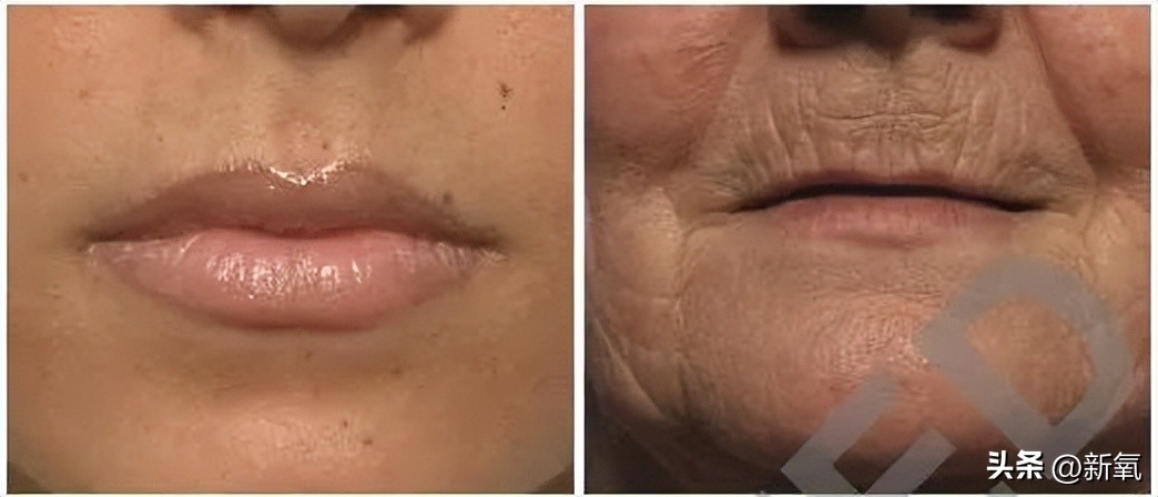 嘴唇薄变丰满,嘴唇变凸变丑怎么办