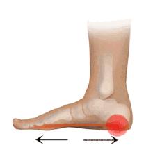 如何判断足弓过低,足弓塌陷对腿型影响