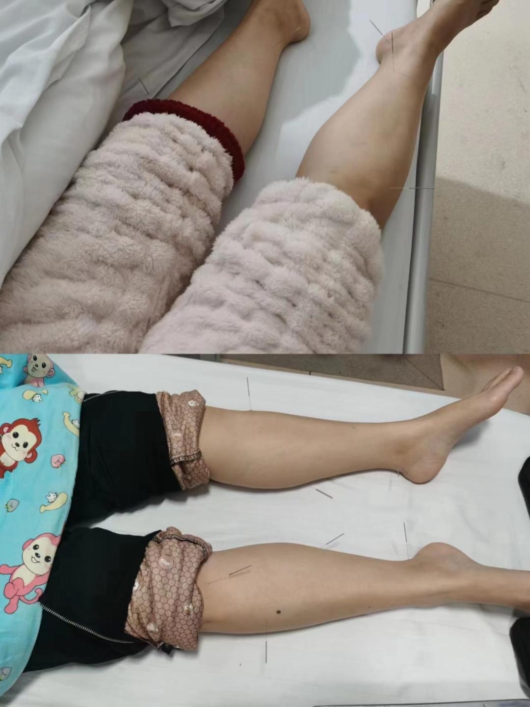 化疗手脚麻吃甲钴胺多长时间好,化疗后手脚麻木中药处方