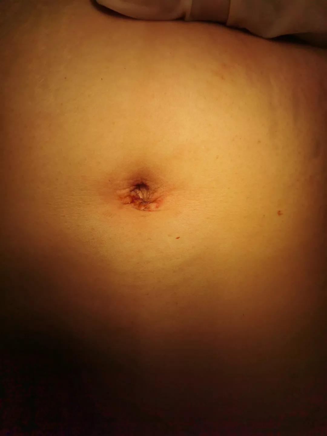 卵巢囊肿微创手术后患者状况,腹腔镜下卵巢囊肿切除术步骤