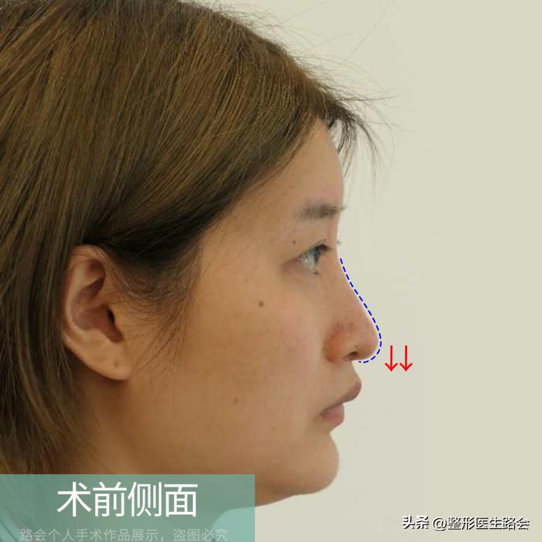 硅胶隆鼻后鼻尖发红怎么回事,单纯硅胶隆鼻一分钟搞定