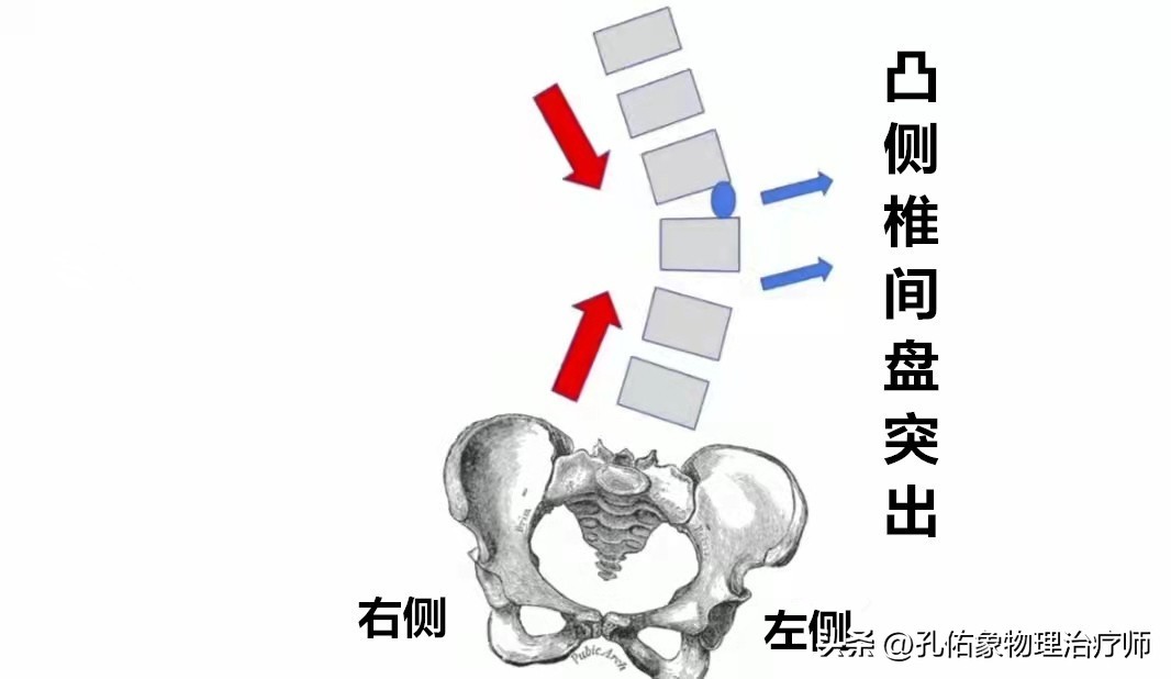 屁股疼是腰突导致的吗,屁股酸痛什么预兆