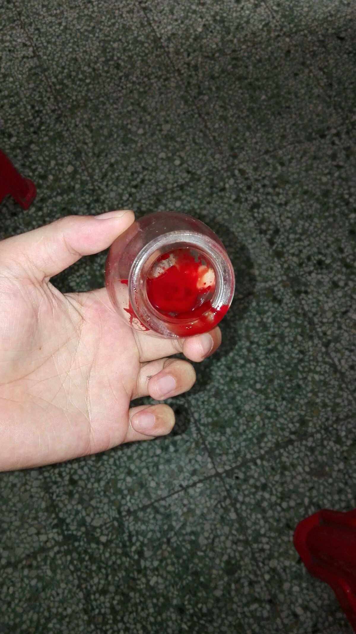 中医脚底筋膜炎如何彻底治愈,筋膜炎肩部最快的治疗方法中医