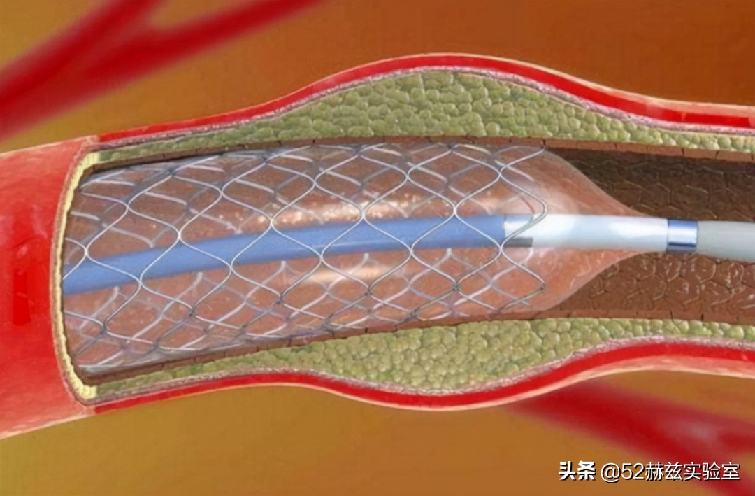 从13000元骤降至700元！看国产心脏支架如何吊打国外？