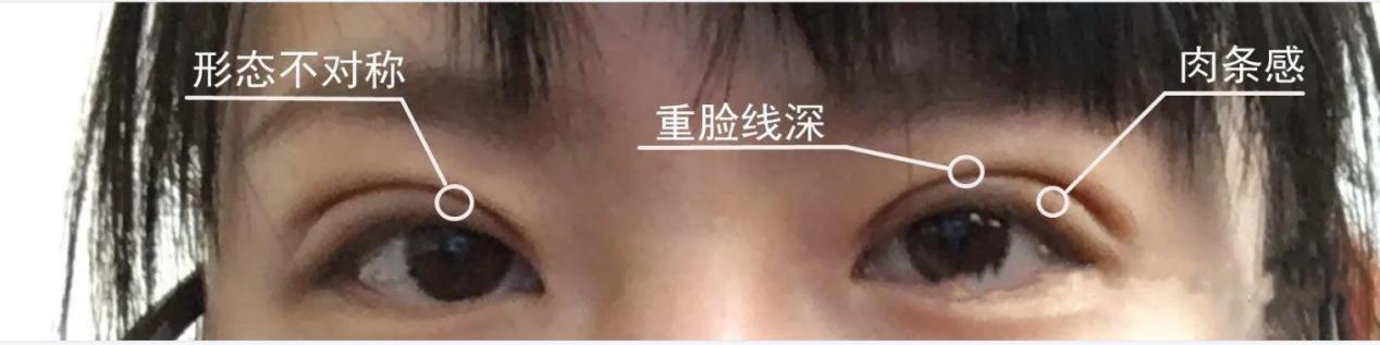 双眼皮手术不对称案例,双眼皮不对称怎么办