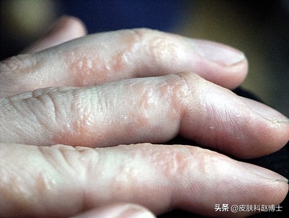 手部角化性湿疹无法痊愈,手部湿疹和汗疱疹的区别