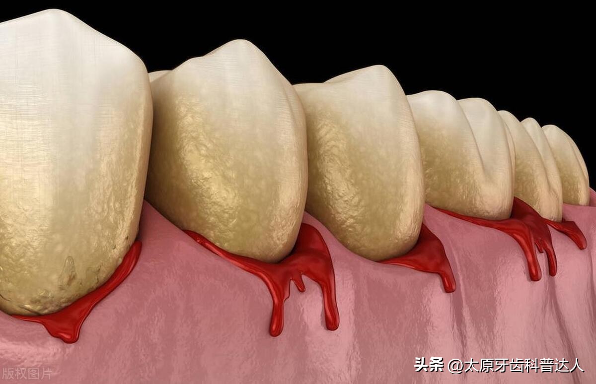 牙周病掉牙的罪魁祸首,老掉牙原来是牙周病作怪