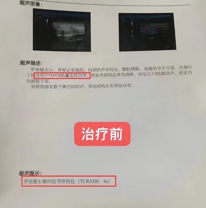 甲状腺4a级多发结节，选来选去，最后还是选择了微波消融