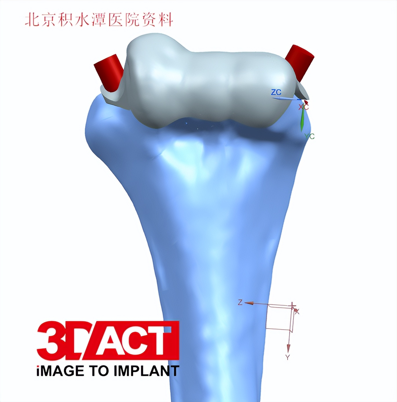 患者是我们最好的老师，也是我们创新的动力——北京积水潭医院蒋协远教授团队完成第二例肘关节表面置换手术
