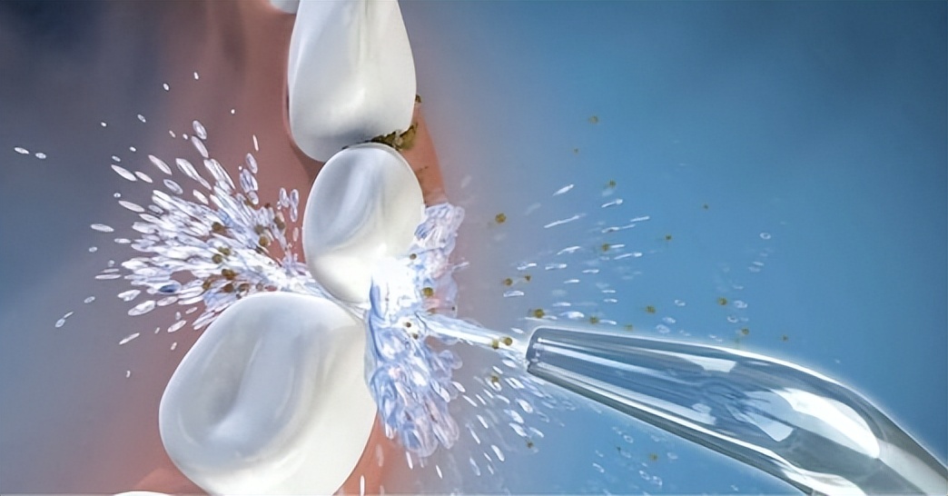 素士和舒客冲牙器哪个好,冲牙器测评素士