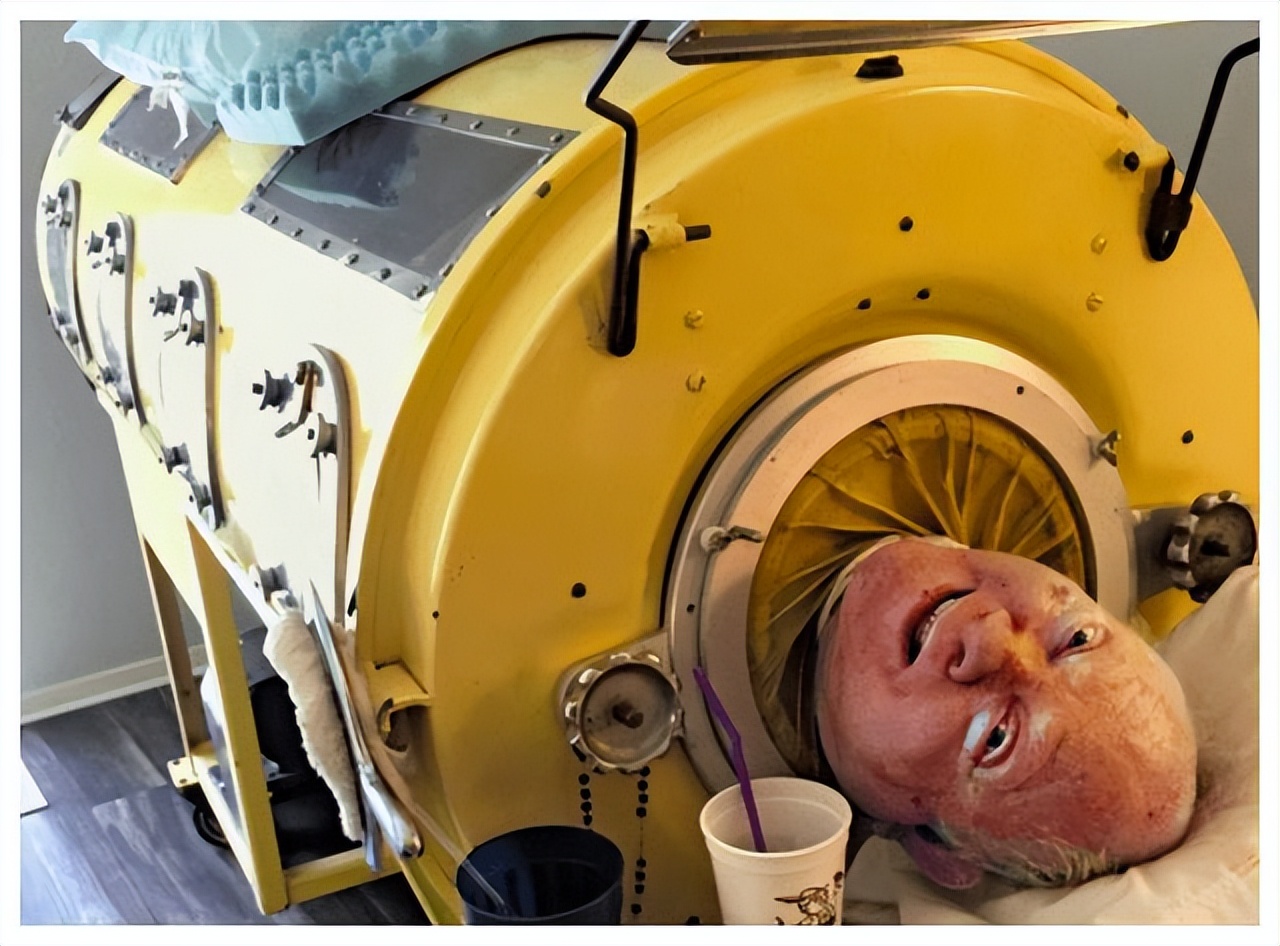 美国铁肺人保罗，被困“铁桶”70年，只能露一颗头，考大学成律师