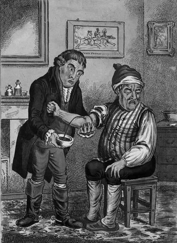 中世纪理发师外科医生,中世纪放血治疗法