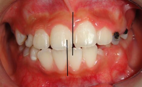 徐州儿童牙齿矫正牙齿不齐,大连口腔医院儿童牙齿矫正怎么样