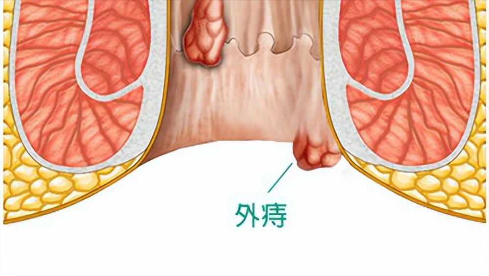 什么情况下医生才建议做肠镜,做过无痛肠镜后身体有什么症状