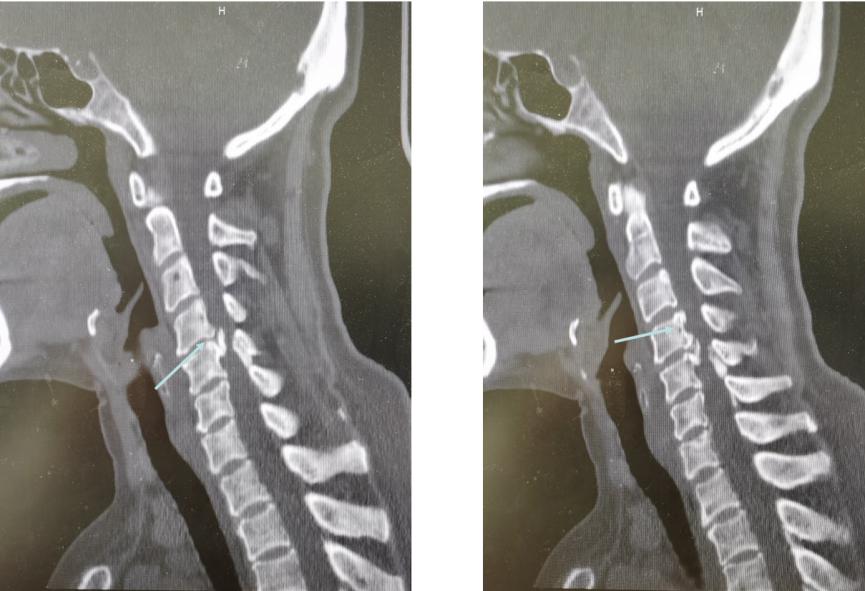 养花达人遇上右臂疼痛，原来是神经根型颈椎病在作祟