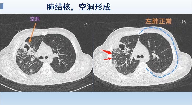 患有肺结核注意事项,19岁肺结核多久导致死亡