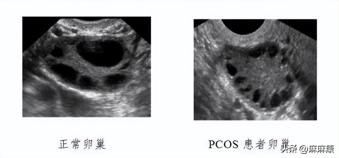 多囊卵巢综合征对生育有什么影响？如何改善？