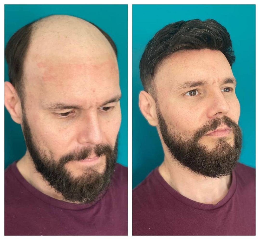 想戴假发不想有刘海怎么办,想戴假发却又没有发网怎么办