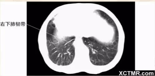 胸腹部盆腔ct主要检查什么,女性盆腔ct断层解剖结构图
