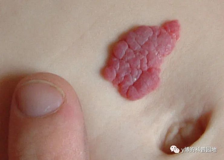 长峰血管瘤医院有门诊与住院之分,长峰血管瘤专科医院小程序