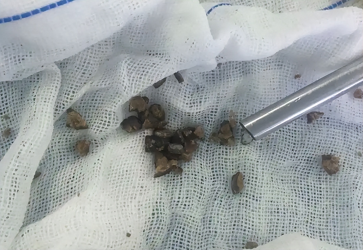 肾结石是什么病，治疗不及时会发生什么？术后护理需要注意些什么