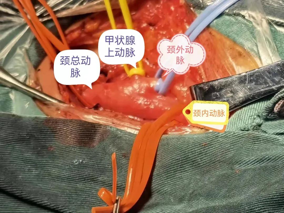 颈动脉剥脱术郑大五附院,中国医大一院颈动脉剥脱术