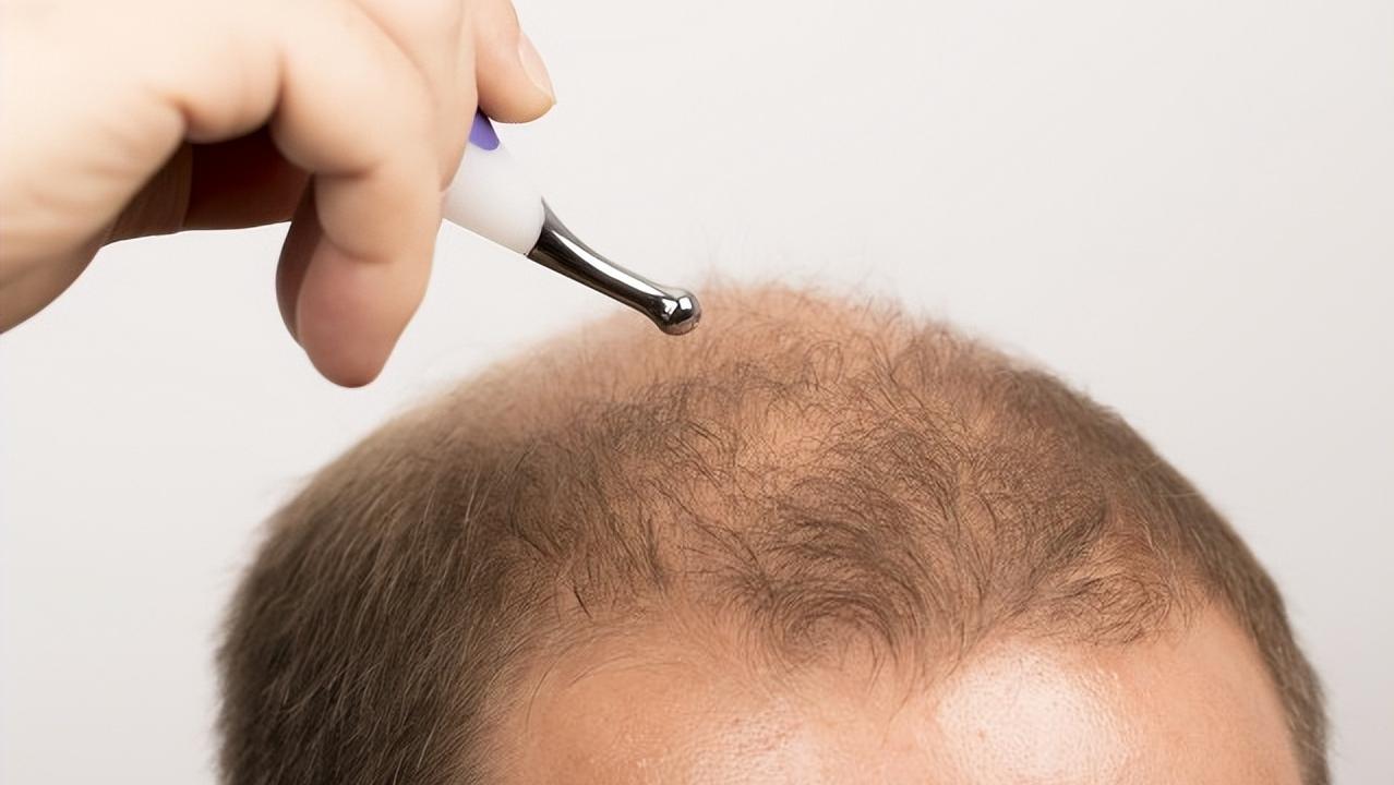 米诺地尔酊有副作用吗,米诺地尔真的有用吗