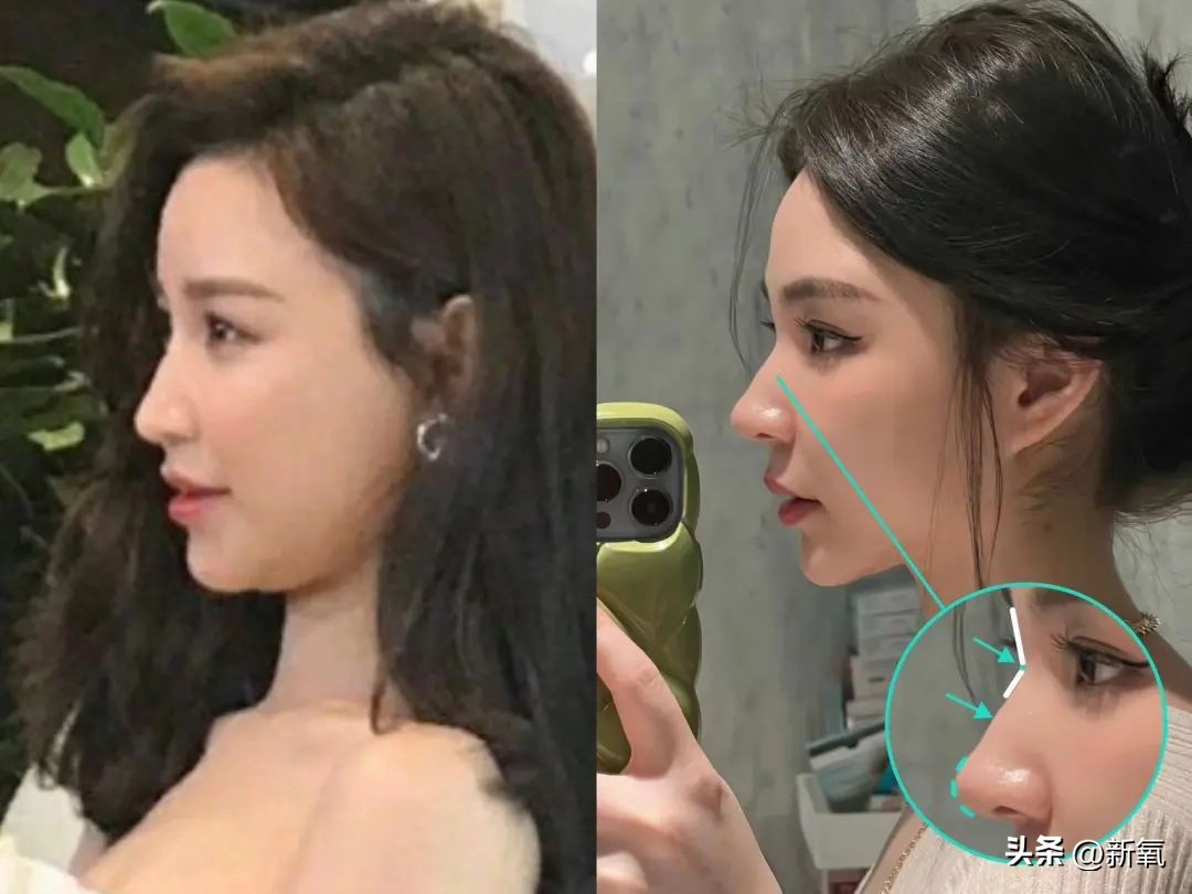 改一点赢很大？她整完鼻子直接美成断代神颜…