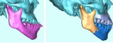 骨性凸牙可以做正颌手术吗,颌骨重建隐形矫正