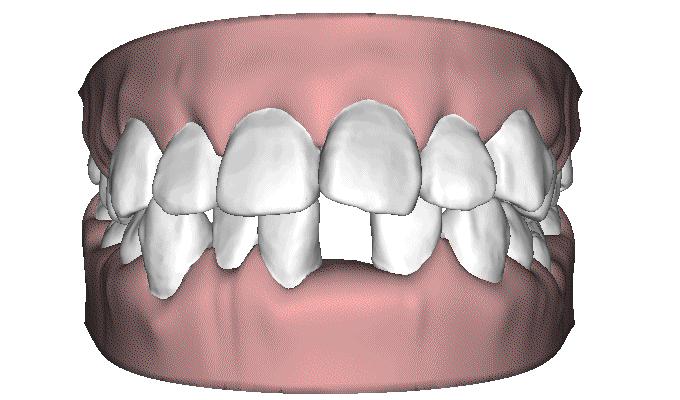 什么样的牙齿无药可救了,常见的牙齿的疾病和处理方法