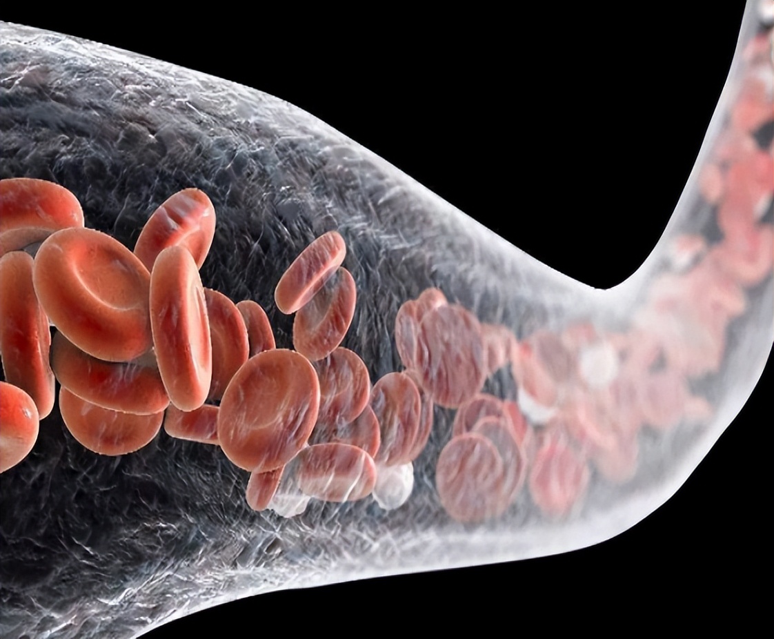 睡觉流口水别忽视可能是脑血栓,睡觉流口水是什么病的早期信号