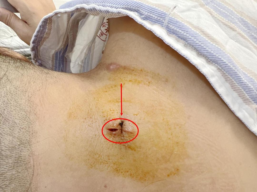 西安椎间孔镜手术治疗颈椎,西安红会医院微创